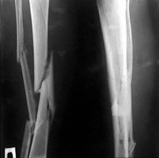 Костер дарк соулс 3. Ds 3 осколок горящей кости. Многооскольчатый перелом голени рентген. Осколок в кости на лодыжки. Осколок кости.