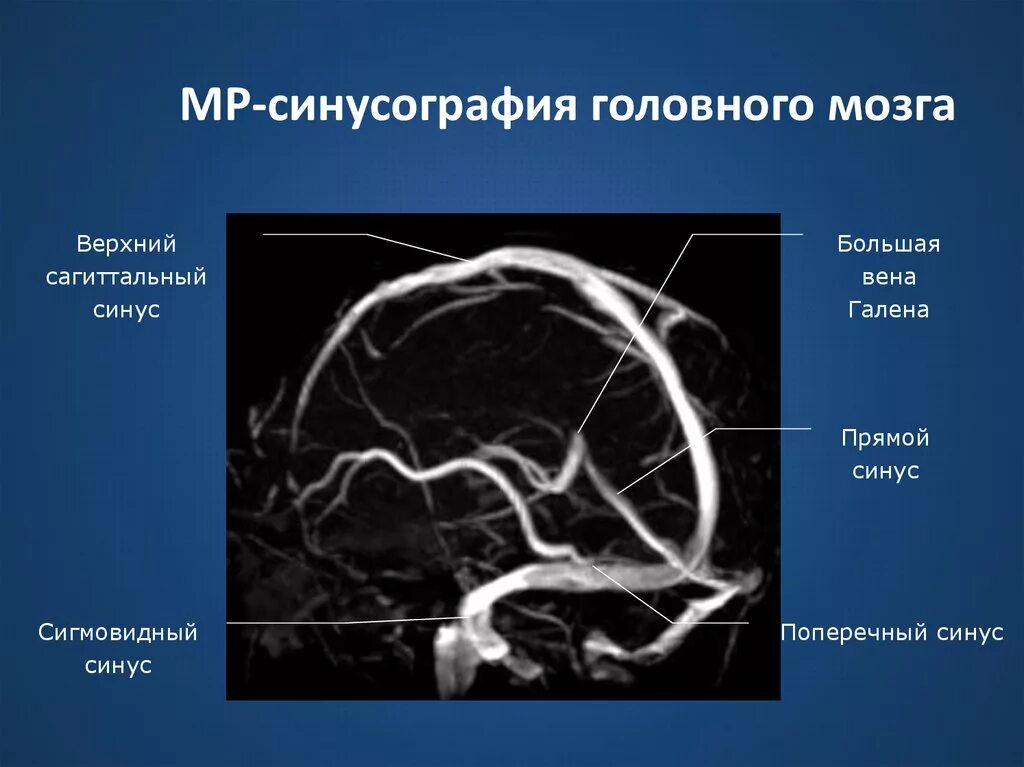 Тромбоз сигмовидного синуса на кт. Гипоплазия сигмовидного синуса. Тромбоз поперечного синуса головного мозга на кт. Тромбоз сагиттального синуса на кт. Гипоплазия правого поперечного синуса