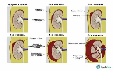 Мкб камень н/3 левого мочеточника. Что то оторвется то при. Что то оторвется то при. Что то оторвется то при. Образование тромба в сосуде.