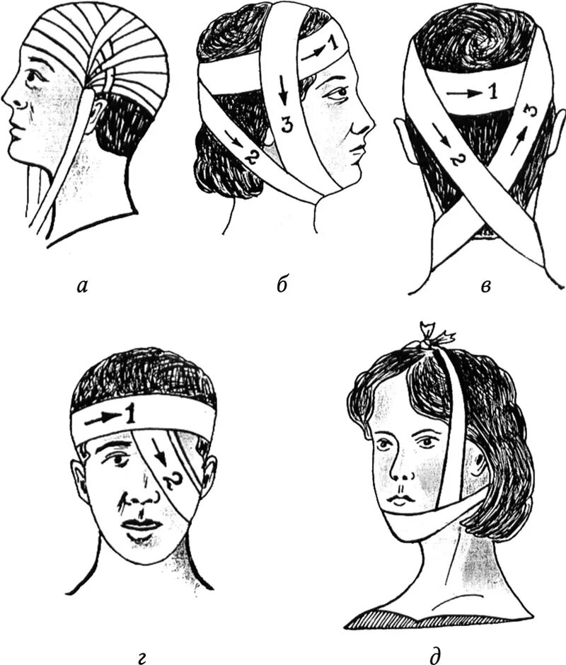 Бинтование чепец. Чепец десмургия. Наложение повязки чепец. Бинтование головы чепец. Как перевязывать голову