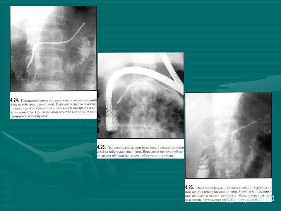 рак поджелудочной клиники