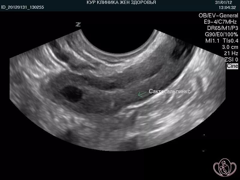 Сальпингоофорит, пельвиоперитонит. Гистеросальпингография ицн. Гидросальпинкс пиосальпинкс. Сактосальпинкс рентген. Сактосальпинкс рентген.
