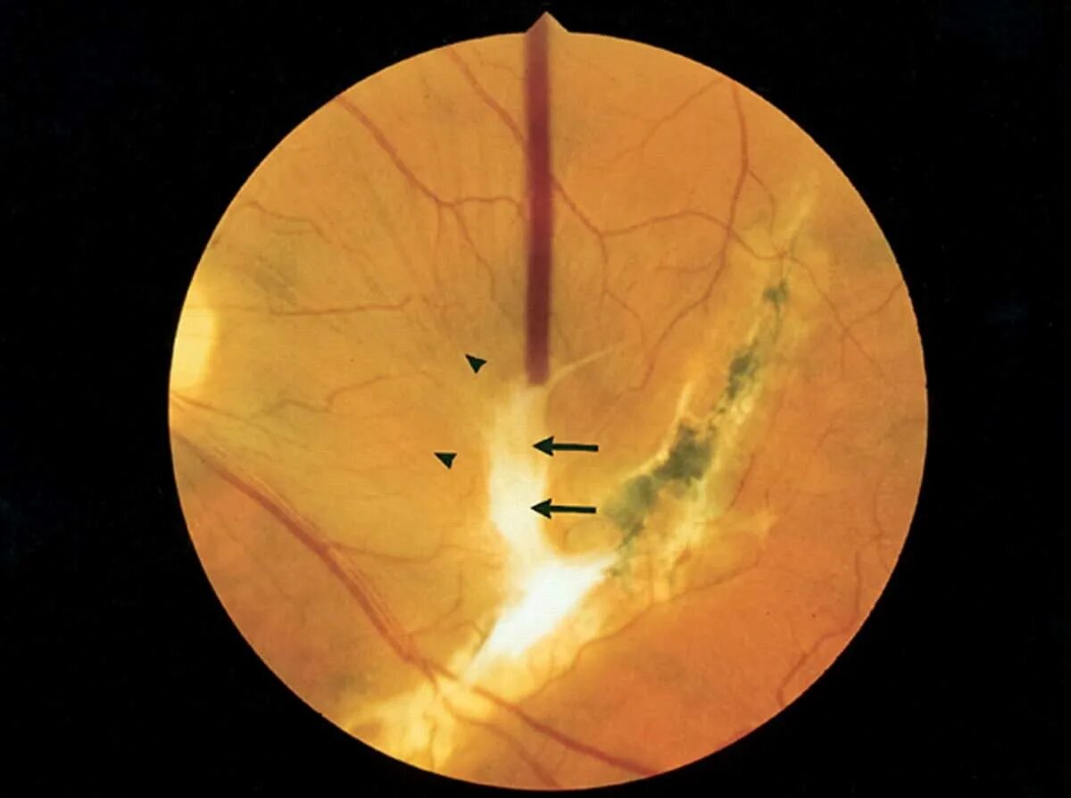 Отслойка сетчатки глазное дно. Тракционная отслойка сетчатки. Макулярная отслойка сетчатки. Клапанный разрыв отслойка сетчатки. Повреждение сетчатки