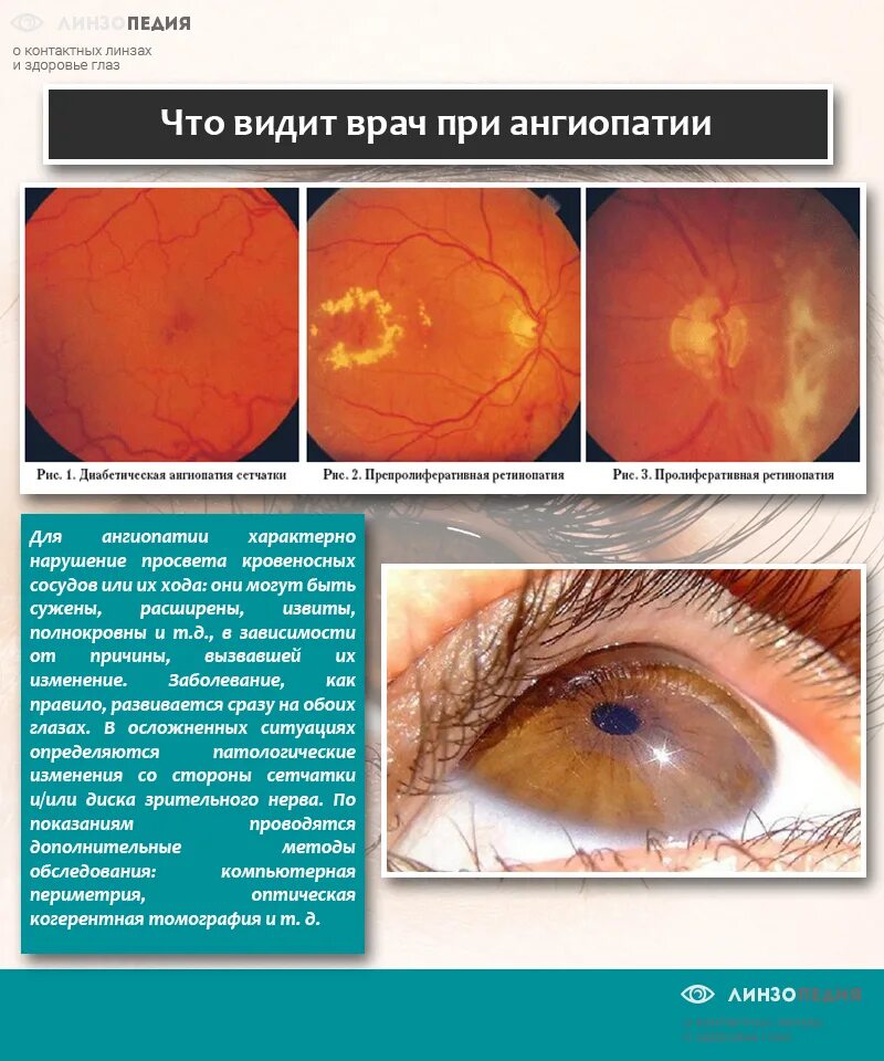 Ангиопатия сосудов сетчатки что это. Гипертоническая ангиопатия сетчатки глазное дно. Гипертоническая ангиопатия и ретинопатия. Глаза при ангиопатии сетчатки. Что такое ангиопатия сетчатки ио.