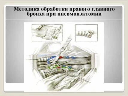 Пульмонэктомия