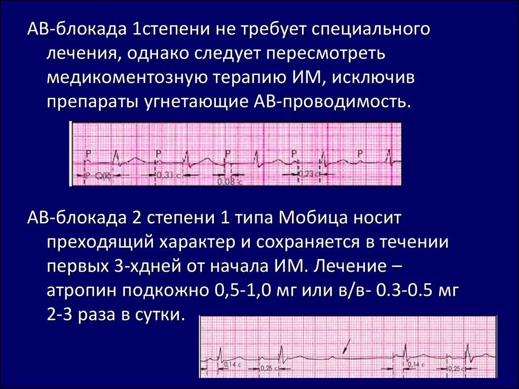 Давление блокада. АВ блокада 1 степени и 2 степени. Блокада 1 степени. Av блокада по степеням. Преходящая блокада 1 -2 степени.