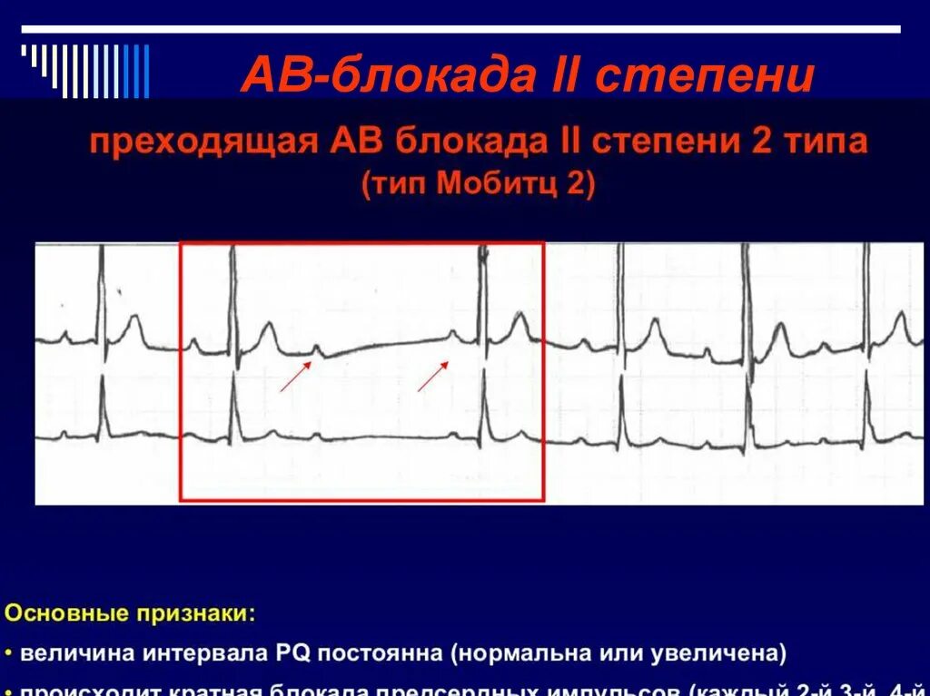 Нарушение блокады гиса. ЭКГ внутрипредсердная блокада av блокада 2 степени. Транзиторная АВ блокада 2 степени Мобитц 1. Нарушение проводимости АВ блокады. ЭКГ нарушения ритма АВ блокада.