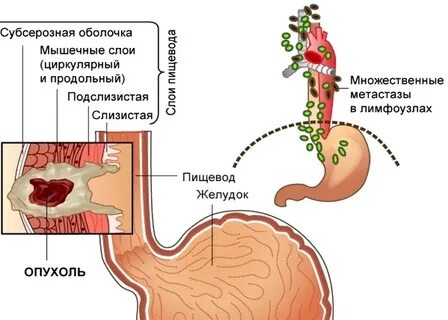 Опухоль 4 степени