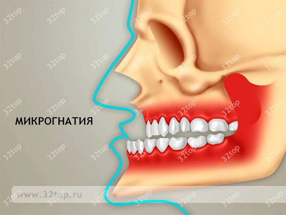 Микрогнатия это