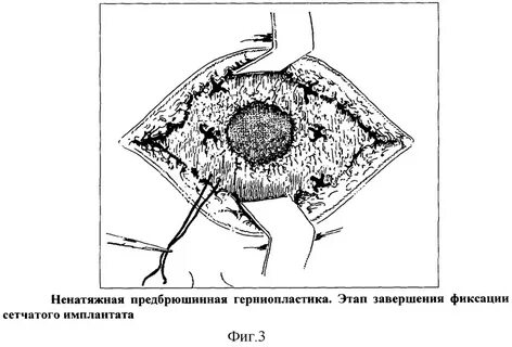 Пупочная герниопластика