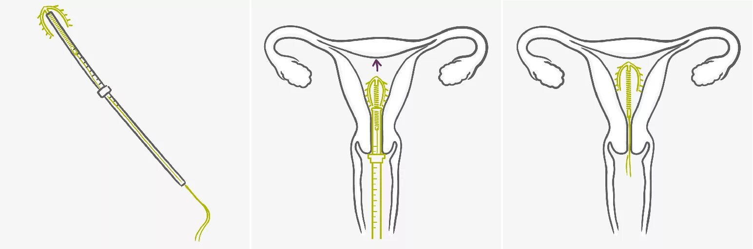 Вмс шейки матки. Контрацепция внутриматочная спираль. Неполная экспульсия вмс что это. Методы контрацепции внутриматочная спираль. Вмс шейки матки.
