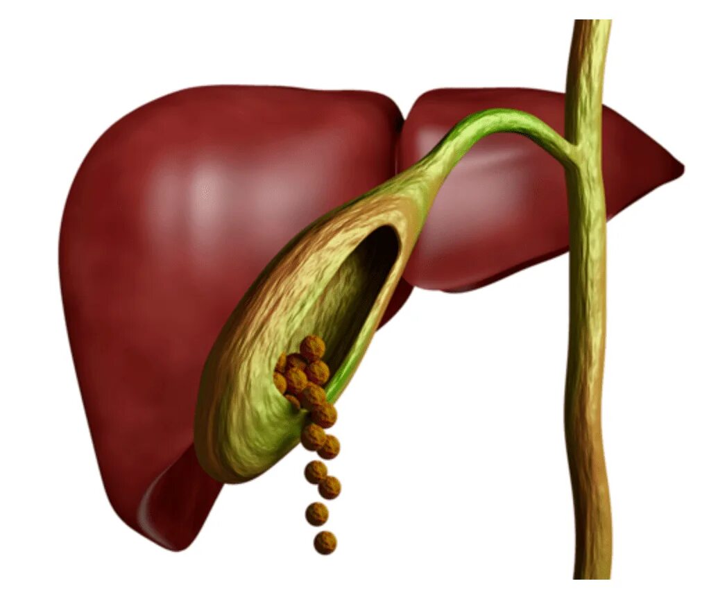 Жкб печени. Желчекаменная болезнь холелитиаз. ЖКБ камни желчного пузыря. Доктор Берг] желчный пузырь (2022). Камень в пузырном протоке желчного пузыря.