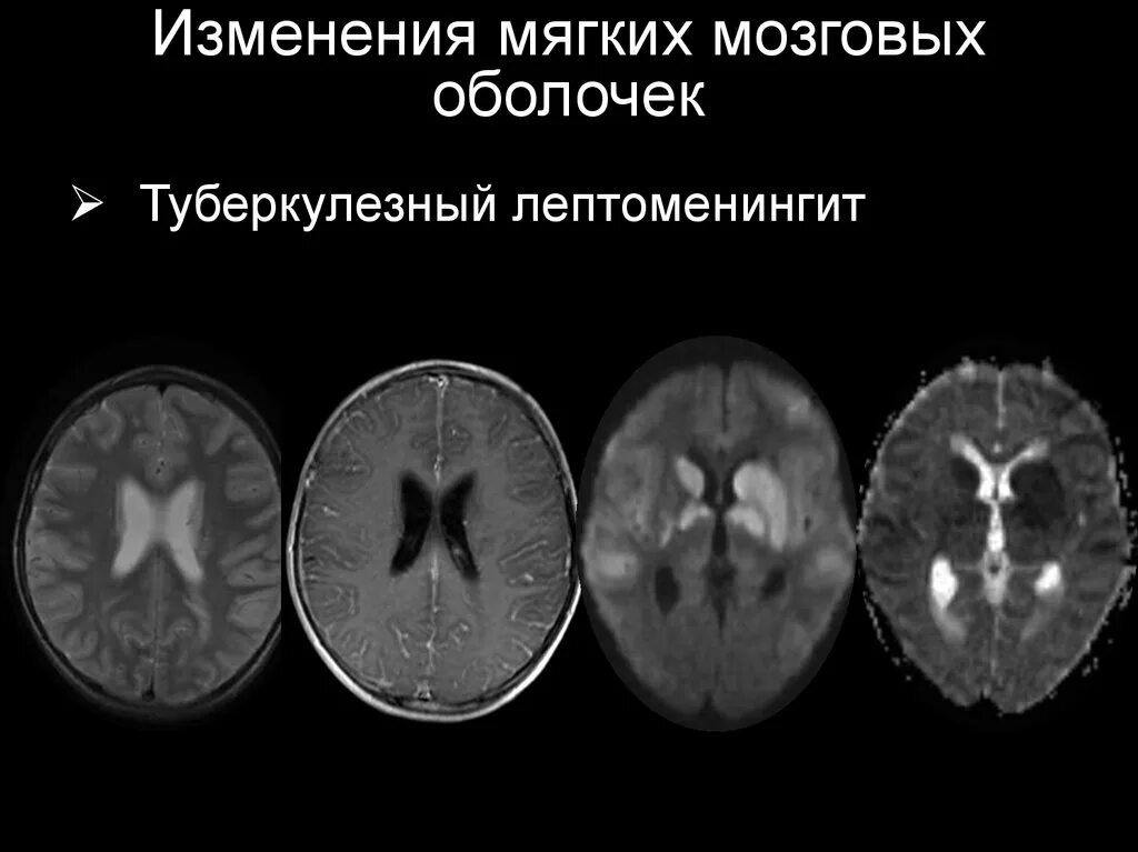 Туберкулез мозговых оболочек