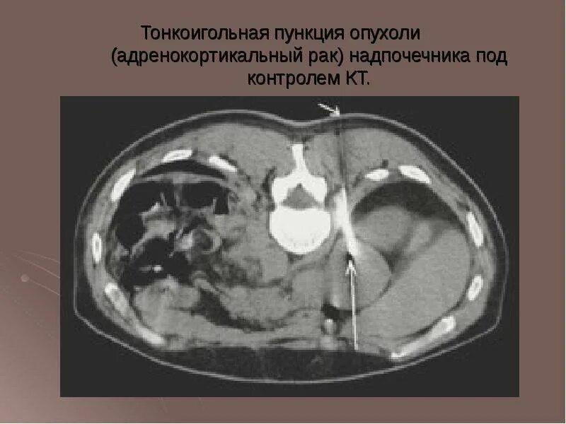 Рак коры надпочечника адренокортикальный рак. Липома надпочечника на кт. Адренокортикальная аденома надпочечника гистология. Адренокортикальная карцинома гистология. Аденома надпочечника гистология.