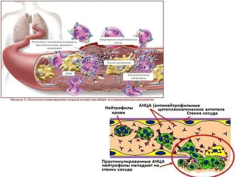 Анца ассоциированные васкулиты. Геморрагический васкулит патогенез. Геморрагический васкулит механизм развития. Системные васкулиты патогенез. АНЦА ассоциированный васкулит.