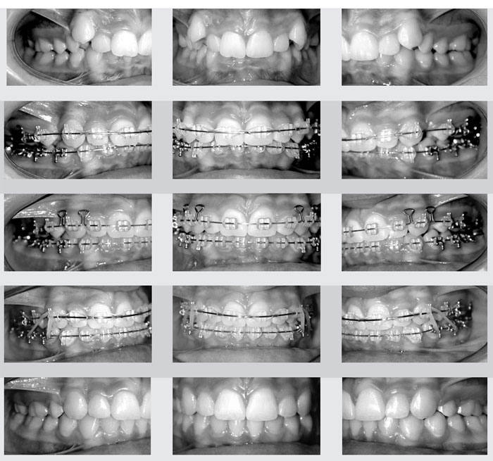 доусон окклюзия. окклюзионный компас в стоматологии схема. доусон окклюзия. смыкание зубов верхней и нижней челюстей в центральной окклюзии. суставной признак центральной окклюзии.