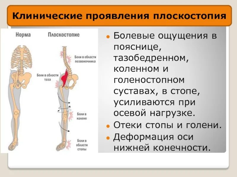 Поясница бедра. Ось конечности нижней конечности. Осевая нагрузка на тазобедренный сустав. Плоскостопие и боль в пояснице. Ось нагрузки на нижние конечности плоскостопие.