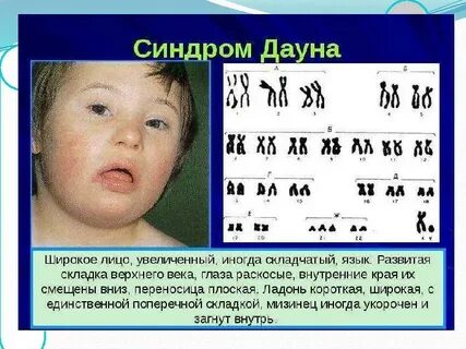 Трисомия 2 пары хромосом