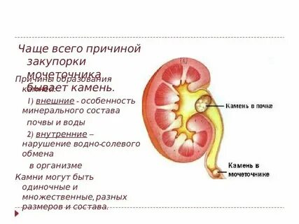Какие боли при камнях в почках