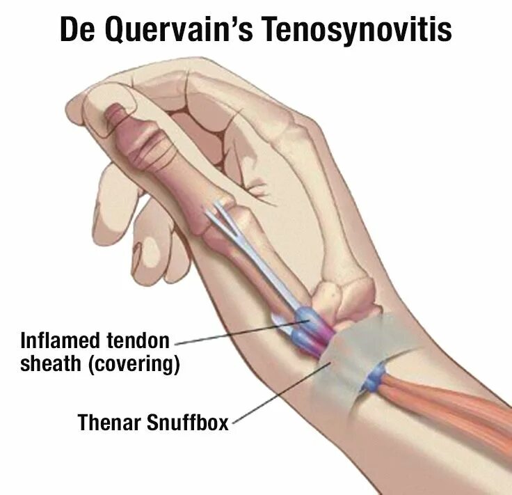 поверхностный сгибатель пальцев. поверхностный сгибатель пальцев мышца анатомия. задняя группа разгибателей предплечья. мышцы сгибатели пальцев кисти анатомия. мышцы производящие движения в плечевом суставе.