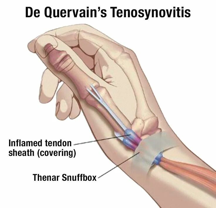 Стенозирующий лигаментит де Кервена. Болезнь де Кервена. Стенозирующий тендовагинит. Воспаление сухожилий разгибателей пальца. Воспаление сухожилия тендовагинит. Болит и щелкает большой палец на руке
