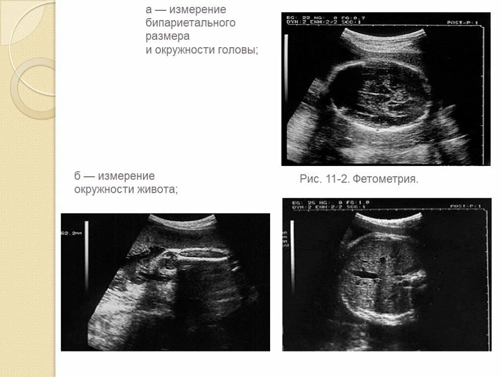 Измерение окружности живота плода УЗИ. Что такое бипариетальный размер плода на УЗИ. Окружность головы УЗИ УЗИ. УЗИ плода измерение головки.