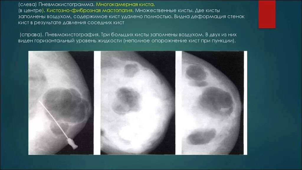 Киста молочной железы фиброзная мастопатия. Фиброзная мастопатия молочных желез рентген. Диффузная фиброзно-кистозная мастопатия рентген. Фиброзно-кистозная мастопатия на кт. O rads слева 1