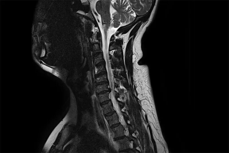 Мрт шейного отдела позвоночника по времени. Мрт позвонков шейного отдела. Грыжа шейного отдела позвоночника мрт. Мрт шейно-грудного отдела позвоночника. Межпозвоночная грыжа шейного отдела мрт.