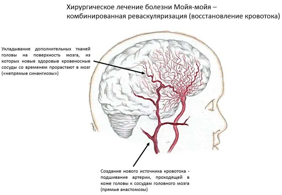 Сосудистые поражения головного мозга. Реваскуляризация головного мозга. Височная артерия у детей.