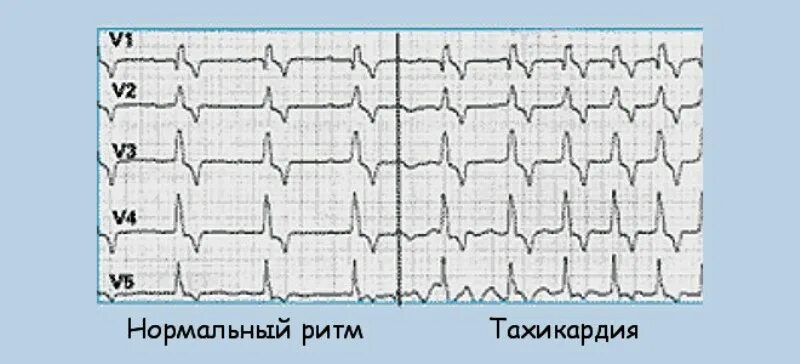 Тахикардия у ребенка 10 лет. Экг при гипертрофии межжелудочковой перегородки. тахикардия и нормальный ритм. гипертрофия межжелудочковой перегородки на экг. ритм при тахикардии экг.