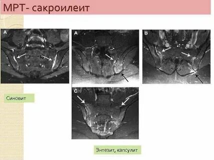 Сакроилеит мрт
