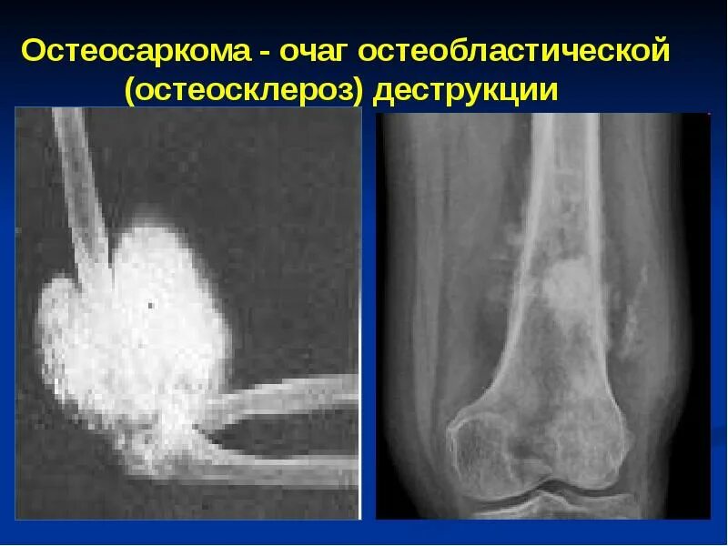 Остеосклероз рентген. Остеосаркома черепа рентген. остеосаркома остеобластическая форма. остеогенная саркома кт.