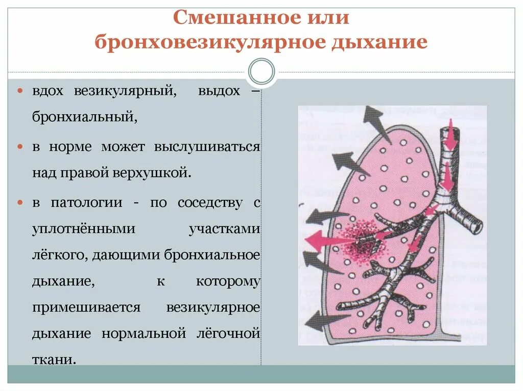 Бронзовезикулярное дыхание. Бронхо везикулярное дыхание. Смешанное бронховезикулярное дыхание. Везикулярное и бронхиальное дыхание.