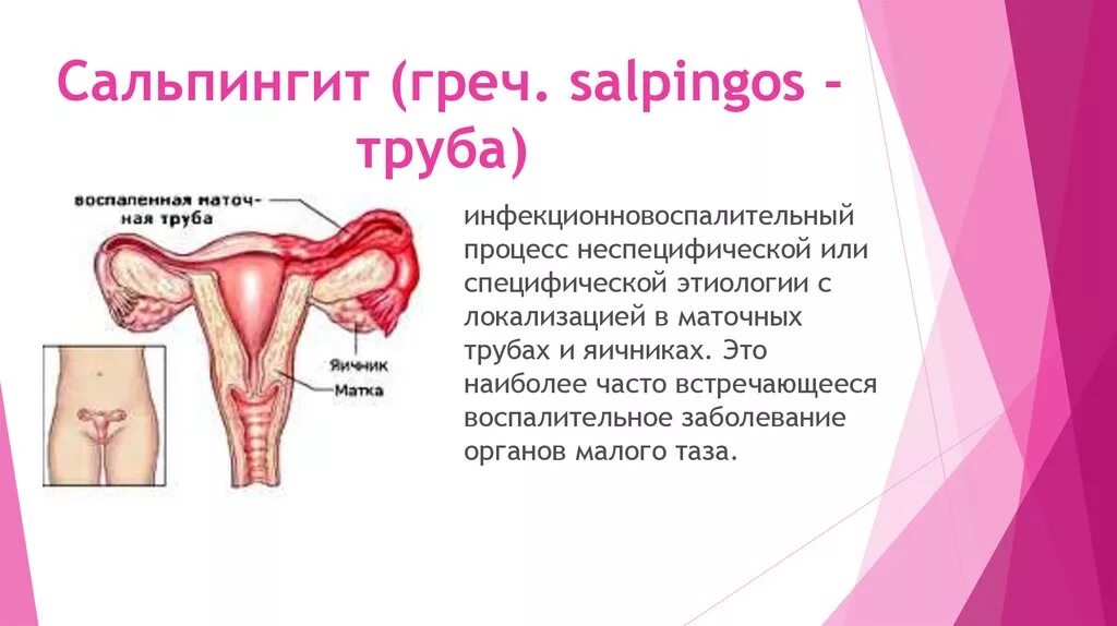 Сальпингит и оофорит что это. Сальпингит – воспалительное заболевание маточных труб.. гонорейный сальпингит.