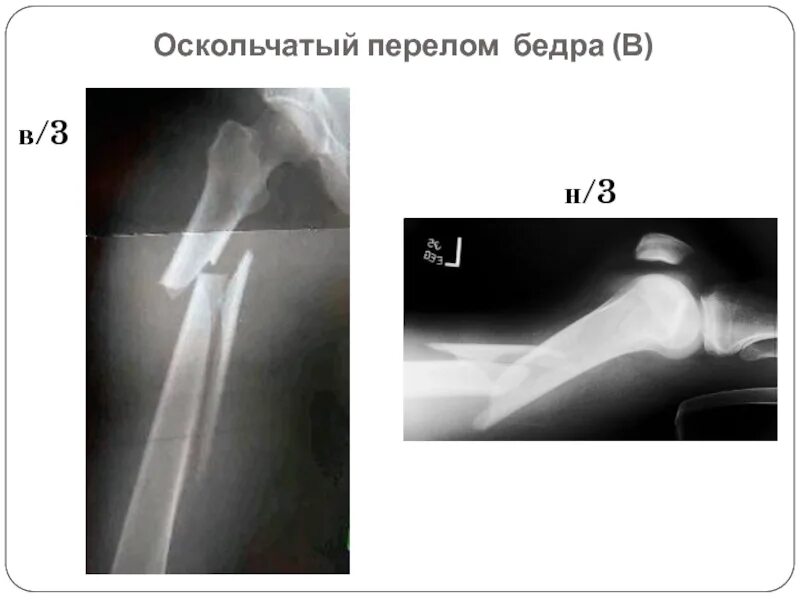 Перелом диафиза бедренной кости рентген. Перелом верхней трети диафиза бедренной кости. Диафизарный перелом бедра рентген. Оскольчатый перелом средней трети бедра. Перелом н 3