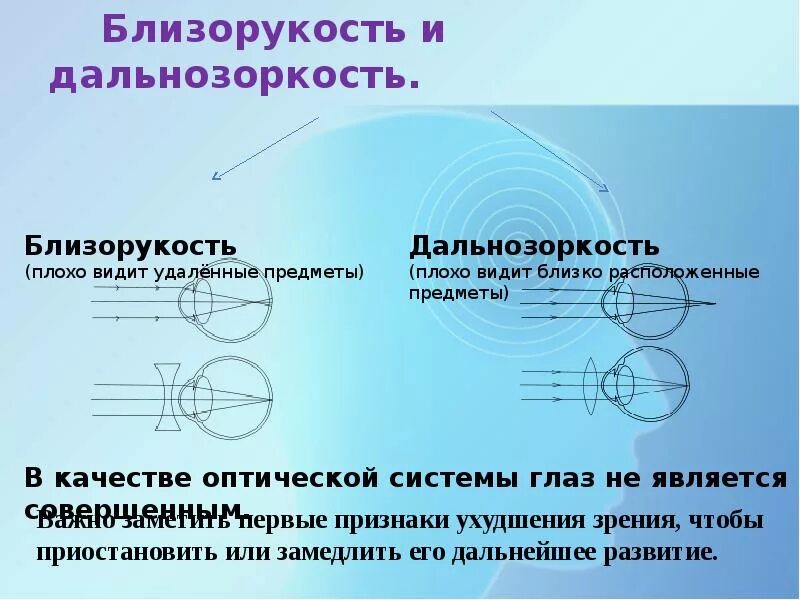 Близорукость причины возникновения. Близорукость и дальнозоркость. Миопия и гиперметропия. Миопия и дальнозоркость. Глаз дальнозоркость и близорукость.