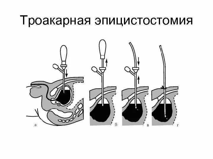 Троакарная цистостомия. Острая задержка мочи троакарная эпицистостомия. Операция троакарная цистостомия. Эпицистостомия этапы операции. Операция мочевого канала