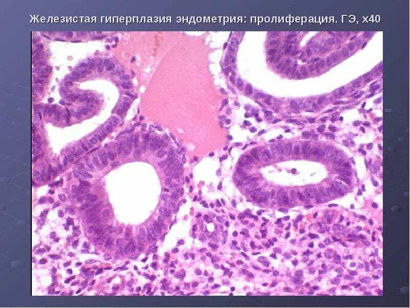 Железисто-кистозная гиперплазия гистология. Железисто-кистозная гиперплазия эндометрия микропрепарат. Гиперплазия матки гистология. Неатипическая железистая гиперплазия.