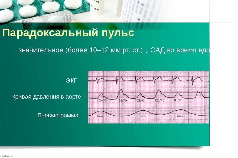 Парадоксальный пульс. Парадоксальный пульс. Парадоксальный пульс. Парадоксальный пульс механизм. Парадоксальный пульс механизм.
