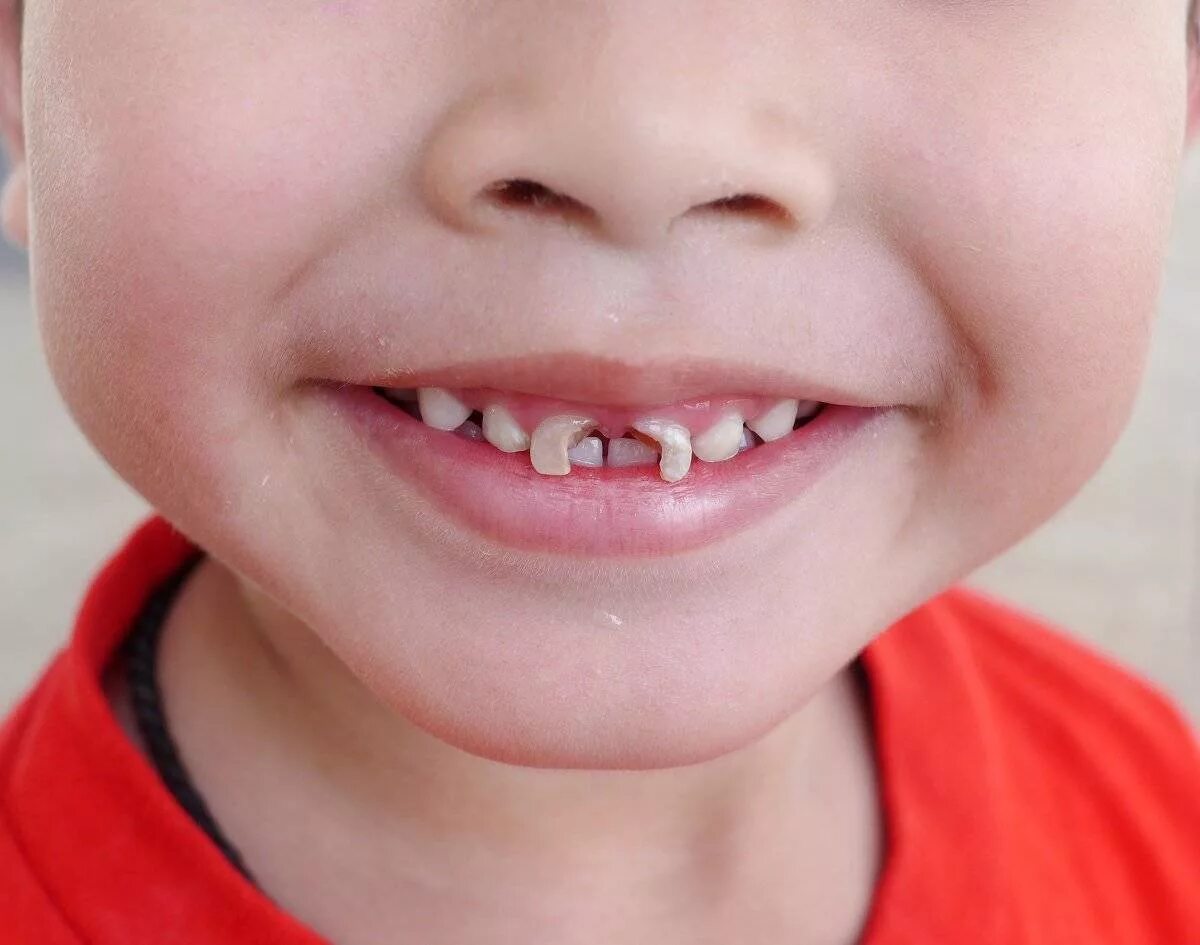 Кариес передних зубов у детей. Кариес передних молочных зубов. Кариес передних молочных зубов у ребенка. Ребенок 3 года не растет