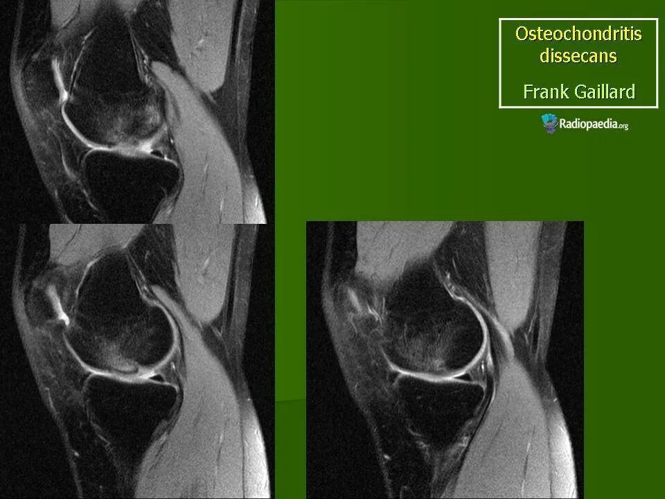 Асептический некроз мыщелка. Остеохондропатия коленного сустава Кенига. Рассекающий остеохондрит кт. Остеохондрит коленного сустава мрт. Асептический некроз коленного кт.