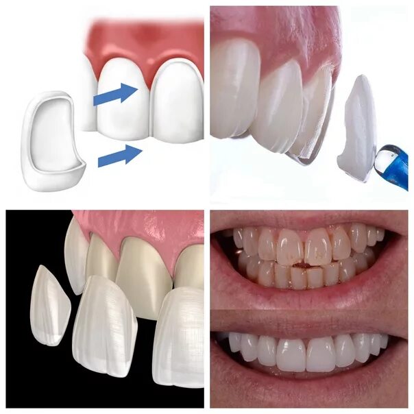 Pin on Perfect smile