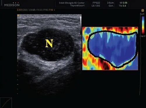 Эластография щитовидной железы что это. Эластография сдвиговой волны щитовидной железы. Эластография щитовидной железы что это такое. УЗИ щитовидной железы с эластографией. Эластография узлов щитовидной железы.