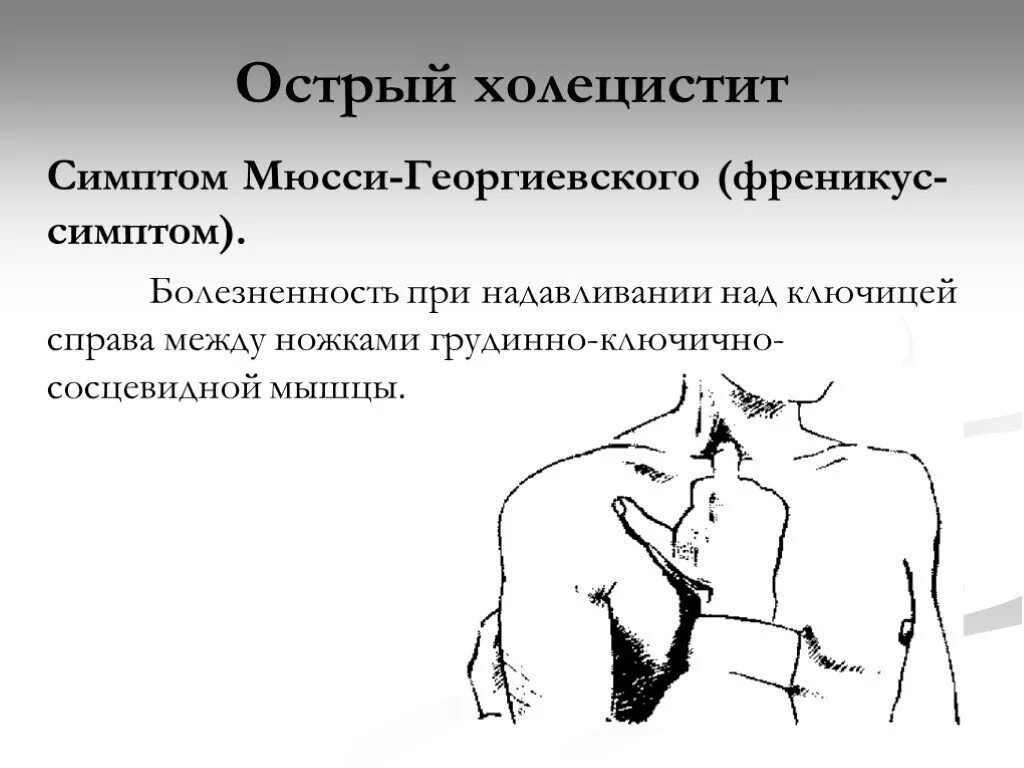 Для острого холецистита характерно. Симптом Мюссе холецистит. Острый холецистит симптом Мюсси. Симптом Мюсси-Георгиевского. Симптомы Кера, Ортнера, Мюсси Георгиевского.