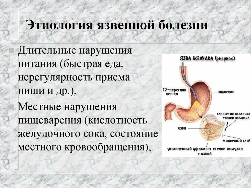 Болезни при кислотности. Этиология язвенной болезни. Этиология язвенной болезни желудка. Желудок и желудочный сок. Кислотность при язвенной болезни желудка.