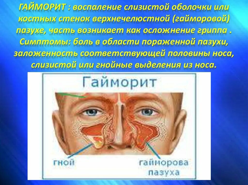 Гайморовых пазух слизистой оболочки. Воспаление верхнечелюстной пазухи. Воспаление гайморовых пазух. Гайморит это заболевание дыхательной системы.