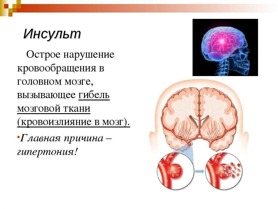 Инсульт 9. Острое нарушение кровообращения в головном мозге вызывающее гибель. инсульт это острое нарушение кровообращения в. инсульт это острое нарушение кровообращения в головном мозге. доклад на тему инсульт.