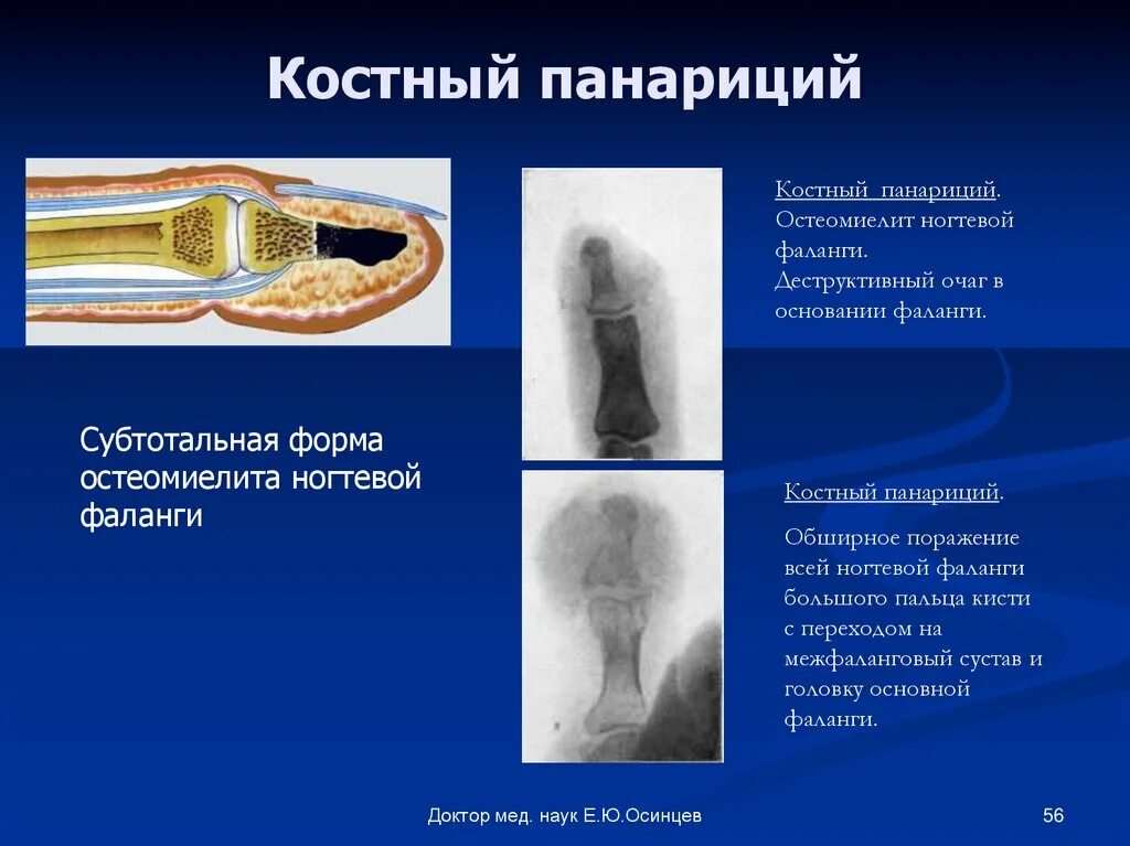 Костно суставной панариций рентген. Костный панариций ампутация. Костный панариций и остеомиелит. Остеомиелит ногтевой фаланги рентген.