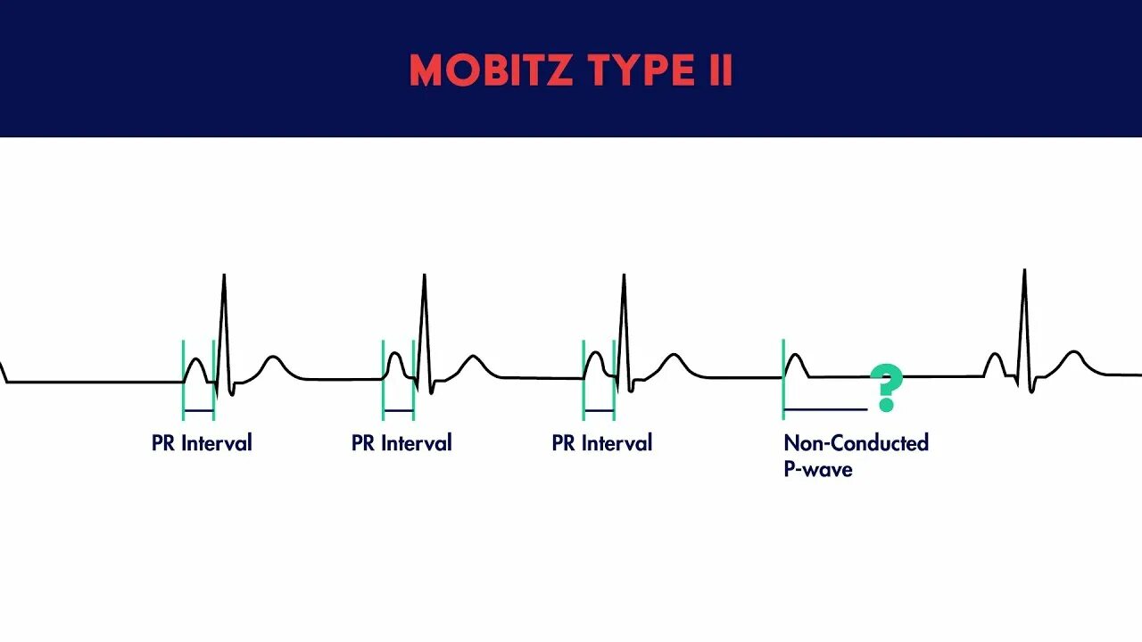 Type i type ii. Av Block ECG. Second degree av Block Type 2. Av Blocks 3 degree ECG. Av Block 2nd degree Mobitz i.