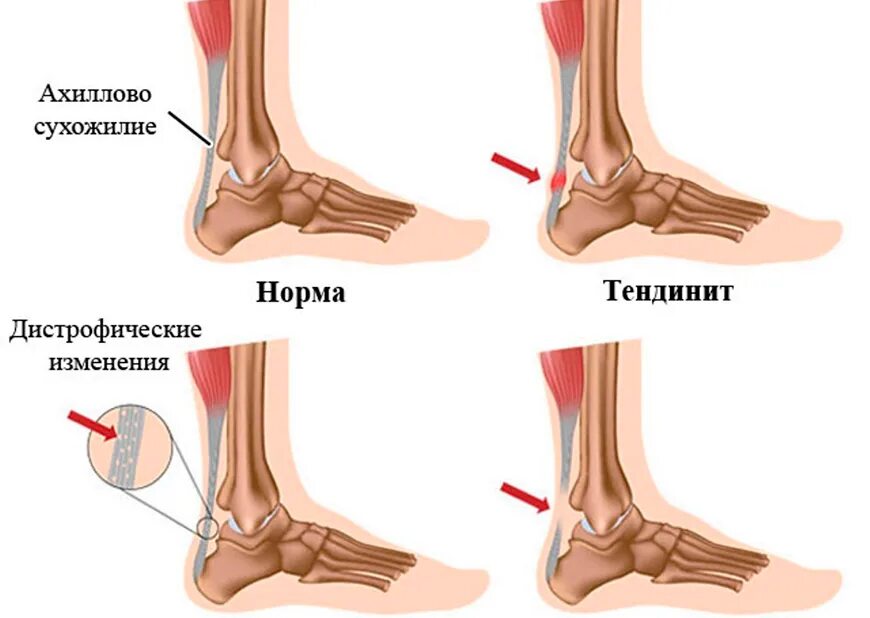 Димексидом голеностопный сустав